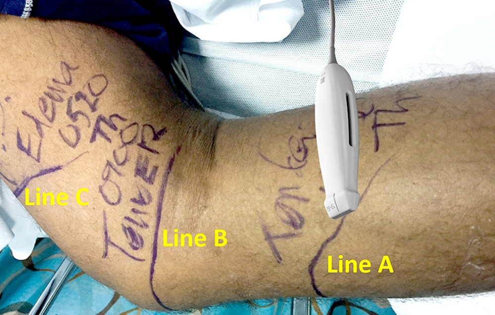 Demonstration of the ultrasound probe place and direction.