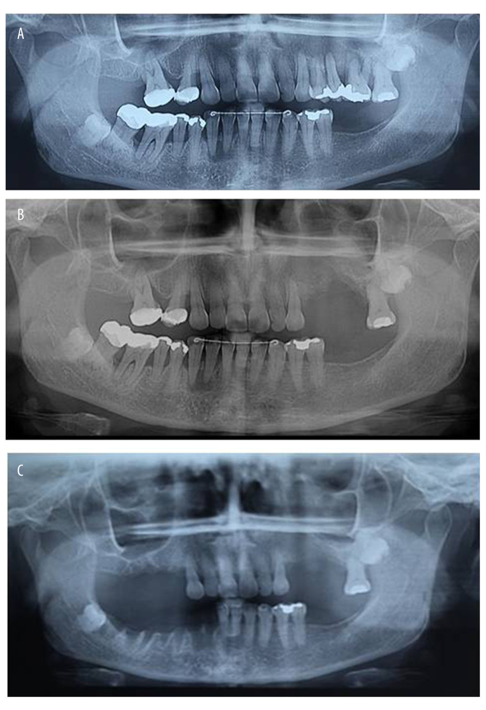 (A) Initial panoramic radiography, showing a radiolucent nondelimited area in the region of the 24, 25, and 26 teeth. (B) Panoramic radiography after the extraction of the teeth. The radiolucent area was recovered. (C) Control panoramic radiography; the lesion did not recur.