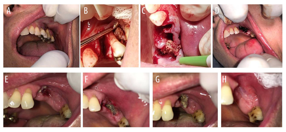 (A) ONJ lesion before the dental extractions. (B) Extraction of the 24, 25, and 26 teeth and necrotic bone curettage. (C) Photograph of the bone sequestration. Note the elastic aspect of the gum. (D) Sutured gum. (E) Presence of necrotic bone after the surgery. (F) Appearance of the area 15 days after the surgery procedure. (G) Appearance of the area 1 month after the surgery procedure, showing bone sequestration. (H) Appearance of the area 6 months after the surgery procedure, showing healing of the total mucosa.