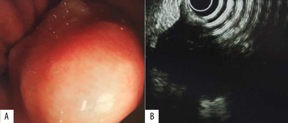 (A) Endoscopic view showing an elevated mass in the gastric antrum with normal overlying mucosa. (B) Endoscopic ultrasound examination showing a hypoechoic, well-demarcated, oval-shaped mass lesion.