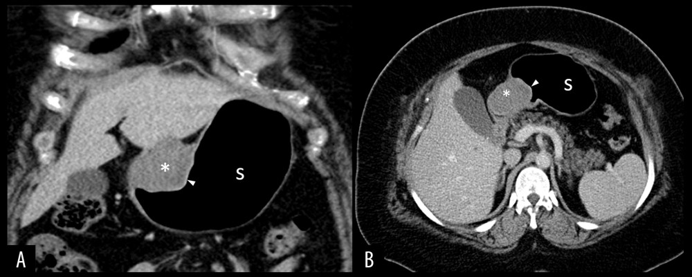 Contrast-enhanced abdominal computed tomography: Coronal (A) and axial (B) images demonstrating the presence of a large, hypodense, homogenous, soft tissue mass (asterisk) on the lesser curvature of the stomach (S), with normal overlying mucosa (arrowhead).