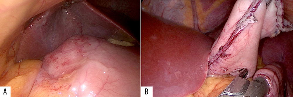 Laparoscopic views showing: (A) the gastric mass on the lesser curvature of the stomach. (B) preparation for Billroth II gastrojejunostomy after the distal gastrectomy.
