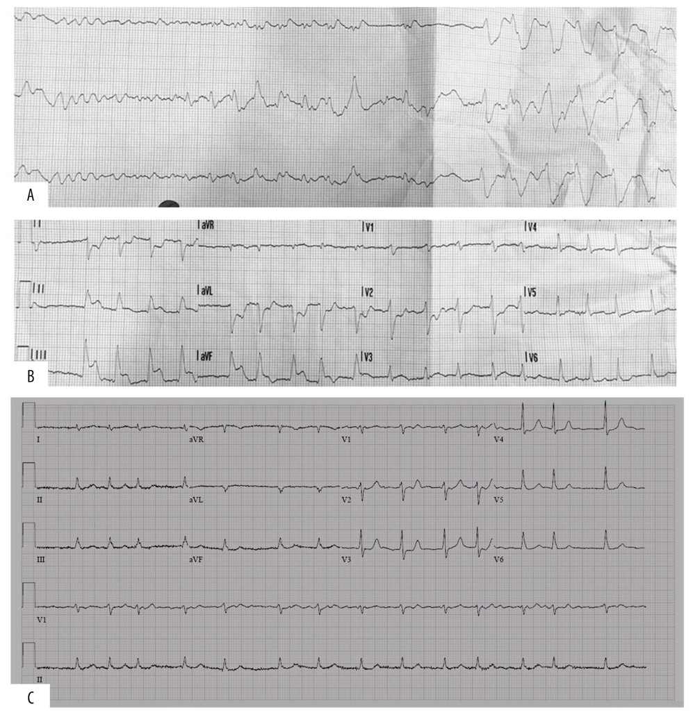 (A) ECG strip showing ventricular fibrillation converting to monomorphic ventricular tachycardia after DC cardioversion. (B) 12-Lead ECG showing ST-elevation in the inferior leads with reciprocal ST-depression. (C) 12-Lead ECG showing atrial fibrillation with nonspecific ST-T changes.