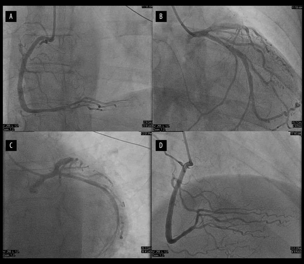 (A–D) Cardiac catheterization showing clean coronary arteries with no evidence of significant atherosclerosis.