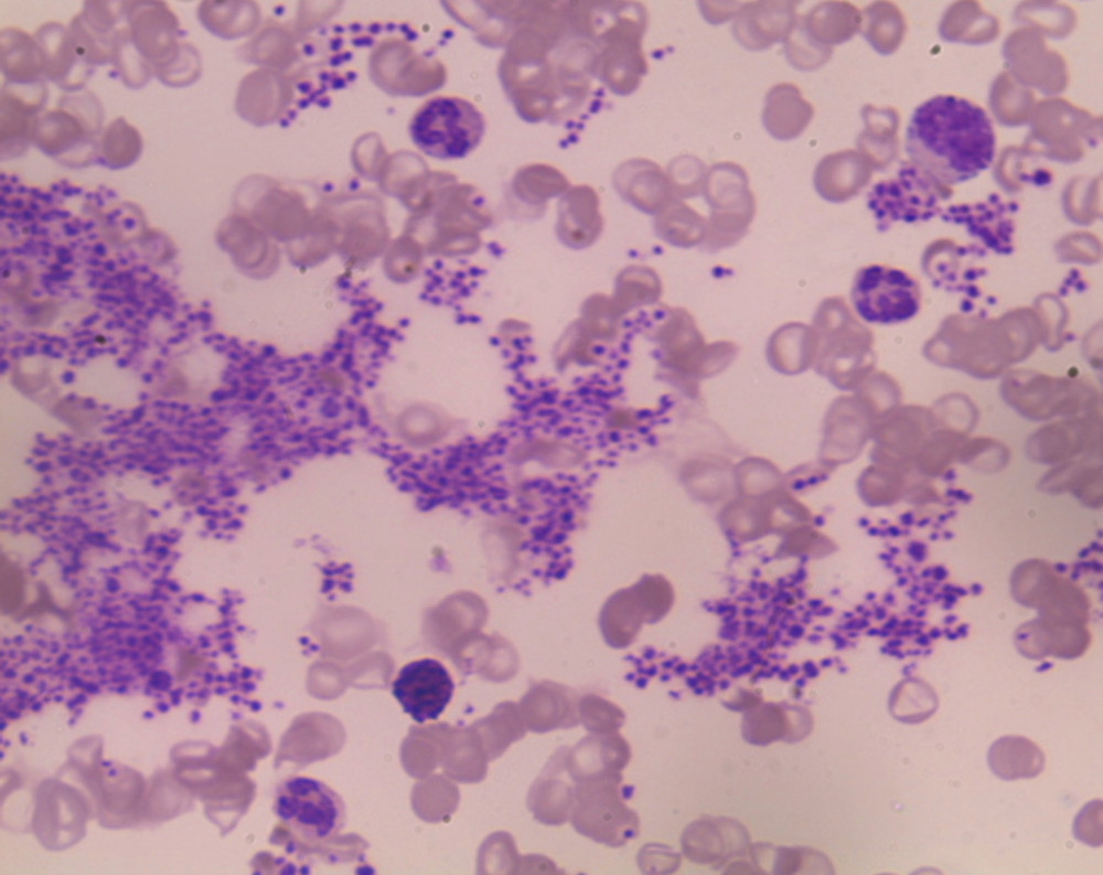 Peripheral blood smear (Leishman stained 400×): large platelet clumps. One myelocyte and basophil is also seen in the background.