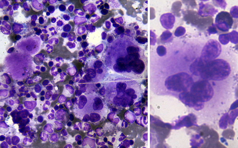 Bone marrow aspirate (Leishman stained 400×): Hypercellular marrow with megakaryocyte cluster. Inset: Hyperlobated megakaryocyte.