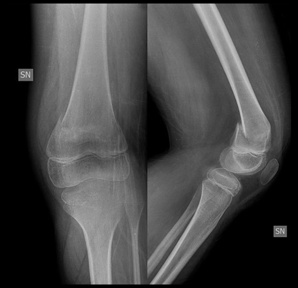Preoperative radiographs of patient A: Age 12.8 years, able to walk without support for short distances before the fracture.