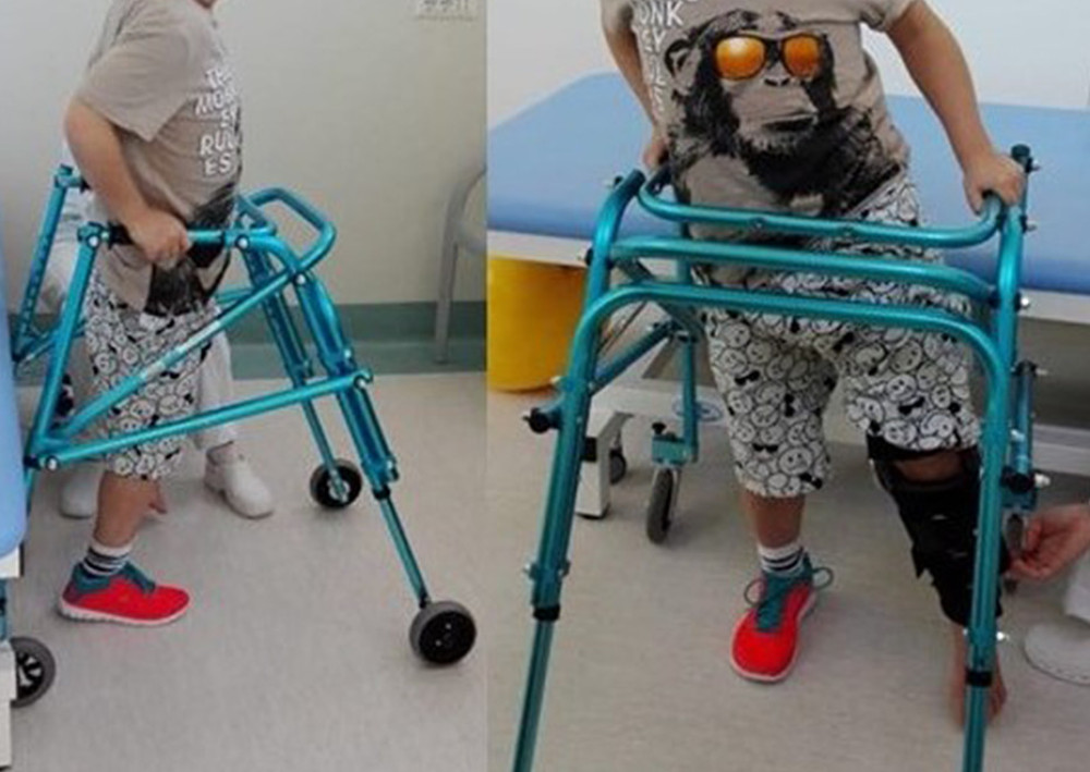 Patient A, 1 week after surgery: standing position achieved with walker support, a knee immobilizer, and no weight-bearing on the operated limb.
