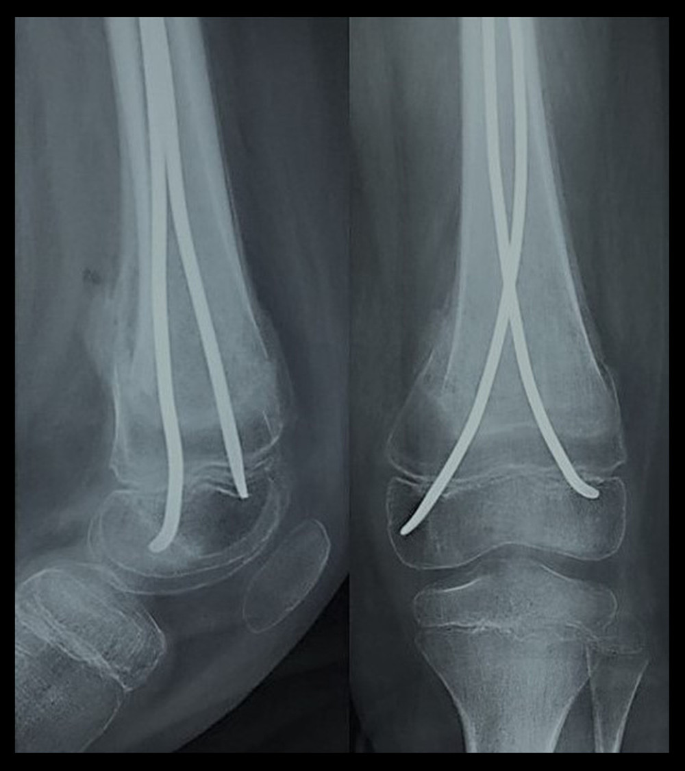 Radiographs of patient A, 2 months after surgery: complete consolidation with normal alignment.