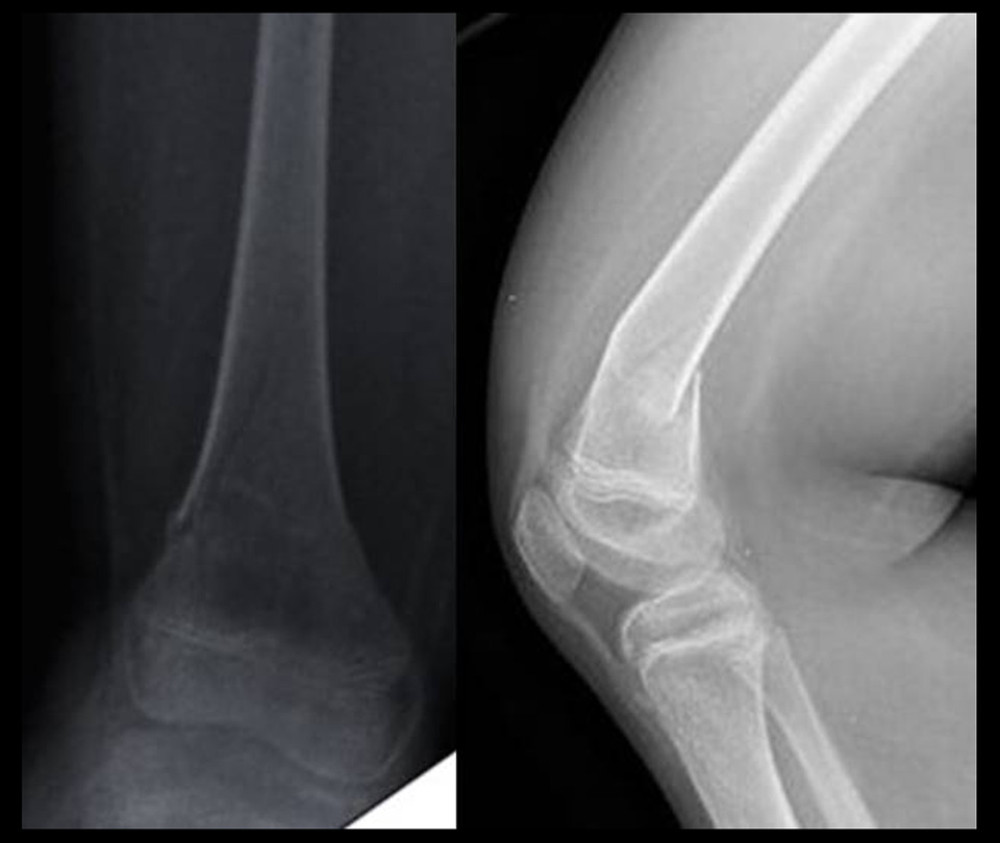 Preoperative radiographs of patient B: Age 11.7 years, able to autonomously maintain the upright position and perform postural passages before the fracture.