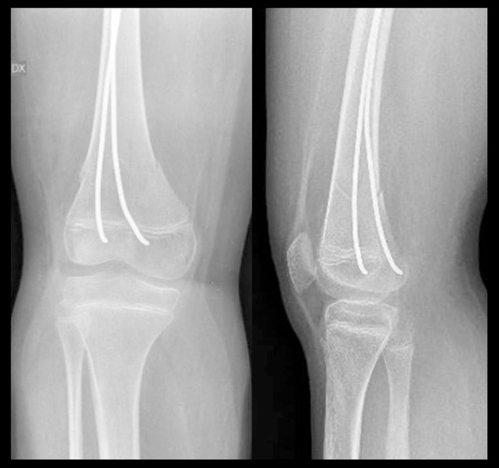 Postoperative radiographs of patient B: achieved reduction in the angulation of flexion.