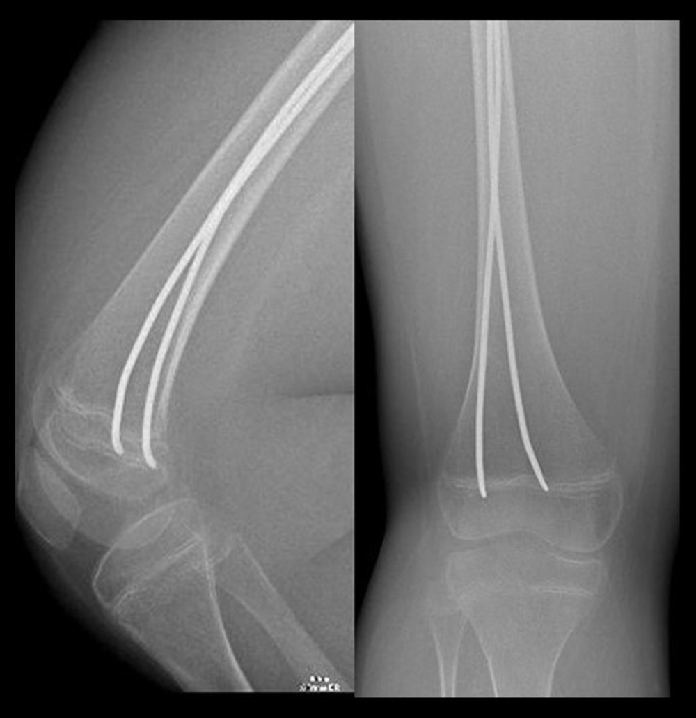 Radiographs of patient B, 1 year after surgery.