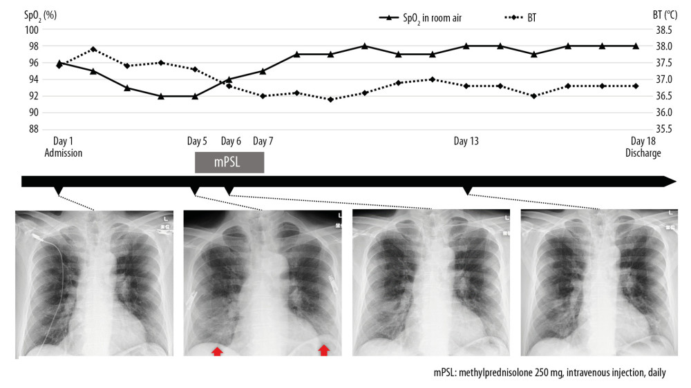 Clinical course of the patient. Chest X-rays revealed worsening diffuse infiltrates (arrow) before systemic corticosteroid therapy. After administration of systemic corticosteroid therapy on days 5–7, chest X-ray images and SpO2 levels displayed immediate and sustained improvement. SpO2 – oxygen saturation; BT – body temperature.