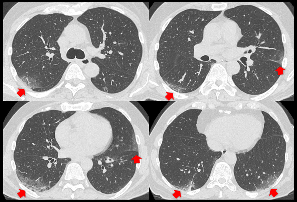 Chest computed tomography images on admission revealed bilateral ground-glass opacity (GGO) in subpleural areas (arrow).