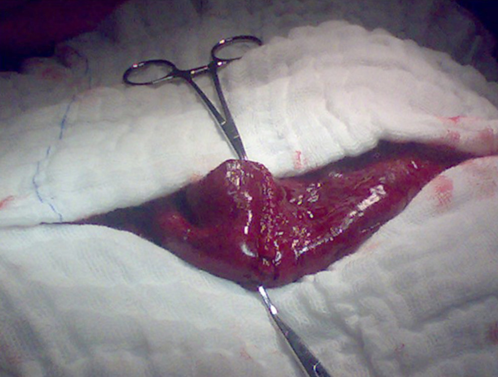 Closure of the transverse incision of the terminal ileum used to remove the retained sponge.