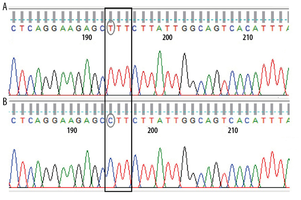 Sanger sequencing electropherograms. Figure 1 illustrates the Sanger sequencing electropherograms of the PCR fragments using the forward KCNJ1 primer for the patient (A) and the wild-type control (B). The mutant, TTT (Phenylalanine: F), and the wild-type residues, CTT (Leucine: C) are circled.