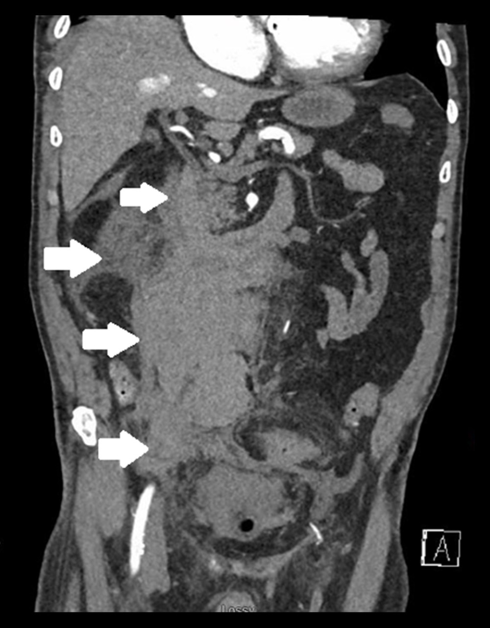 Initial presenting imaging of retroperitoneal hematoma. Coronal imaging of the patient’s presenting CTA scan demonstrating a poorly-defined hematoma beginning in the right hemi-abdomen near the duodenum and expanding inferiorly towards the pelvis, indicated by white arrows.