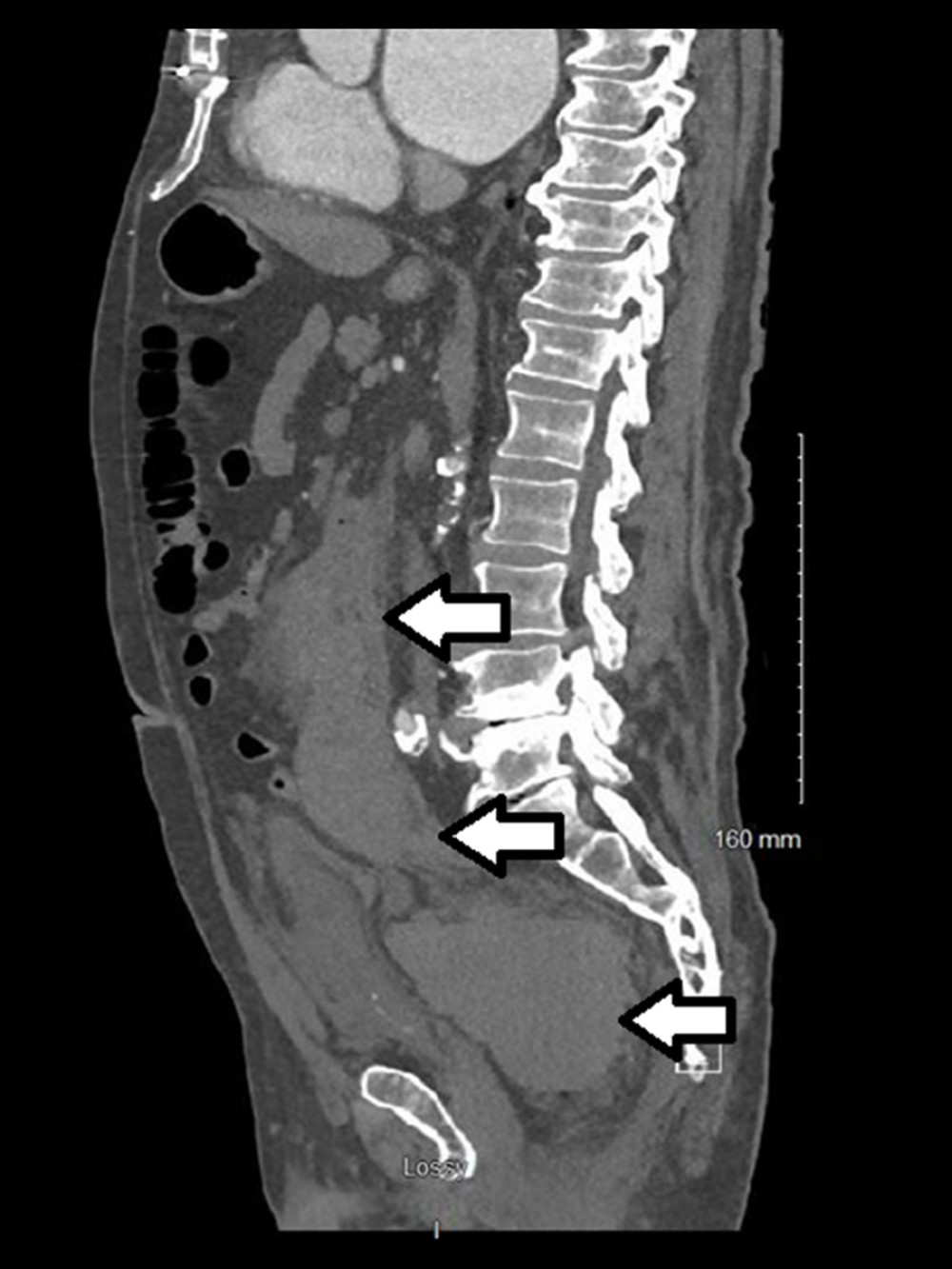 Initial presenting imaging of retroperitoneal hematoma. Sagittal imaging of the patient’s presenting CTA scan demonstrating a poorly-defined hematoma beginning in the right hemi-abdomen near the duodenum and expanding inferiorly towards the pelvis, indicated by the white arrows with black outline.