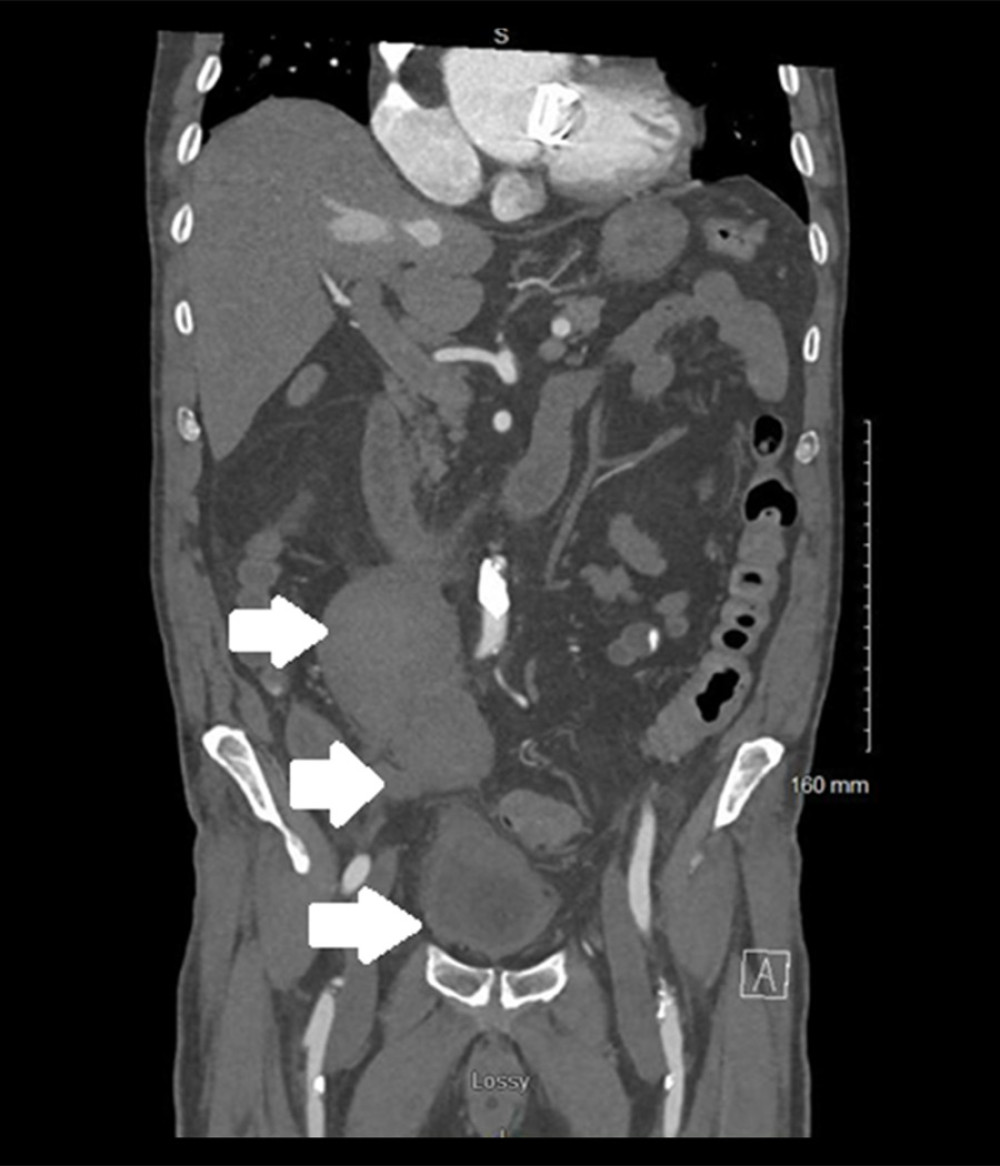 Increasing size of retroperitoneal hematoma with site of bleeding and pseudoaneurysm. After a second fall, the patient returned to the Emergency Department for further evaluation, where repeat computed tomography imaging was performed. The new imaging displayed a better-defined hematoma collection and an increase in size of the hematoma, indicated by the white arrows.