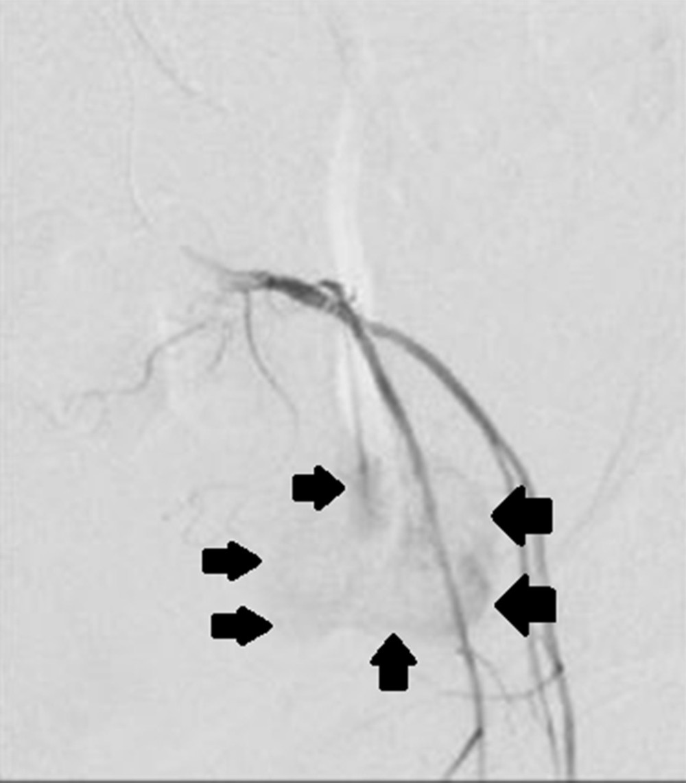 Pelvic angiogram displaying a large superior rectal artery pseudoaneurysm. Demonstration of inferior mesenteric artery angiographic imaging in which a contrast blush suggestive of a superior rectal artery pseudoaneurysm was identified, indicated by black arrows.