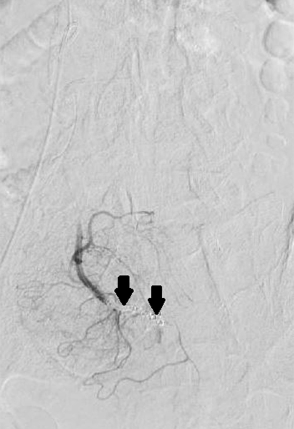 Control of superior rectal artery pseudoaneurysm after coil embolization. Inferior mesenteric artery angiographic imaging revealing the cessation of flow to the superior rectal artery pseudoaneurysm following successful coil embolization of the supplying vessel. This imaging shows no further active contrast blush, and the site of the coil embolization is indicated by black arrows.