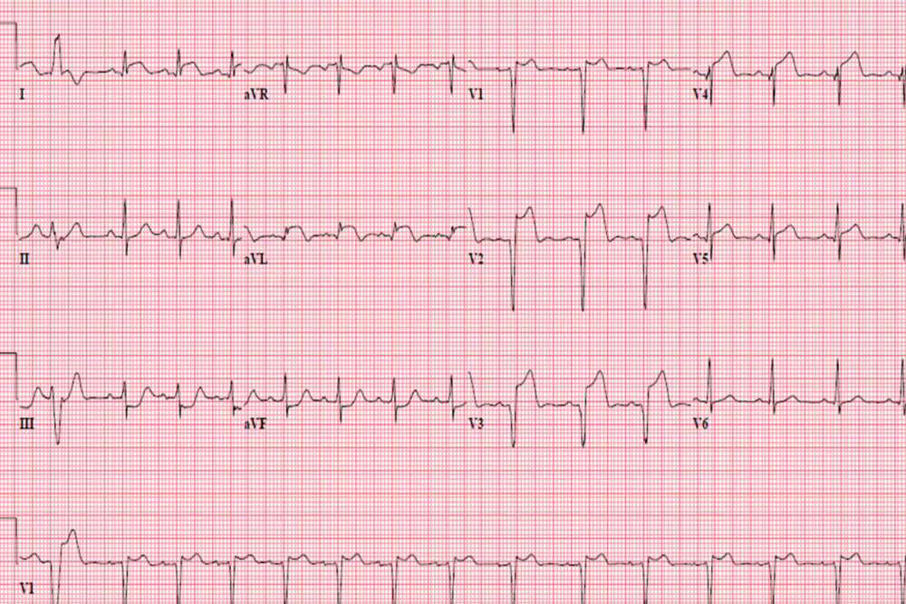 EKG on admission, demonstrating ST segment elevation in V2, V3 and V4, consistent with an anterior myocar-dial infarction in the left anterior descending artery.