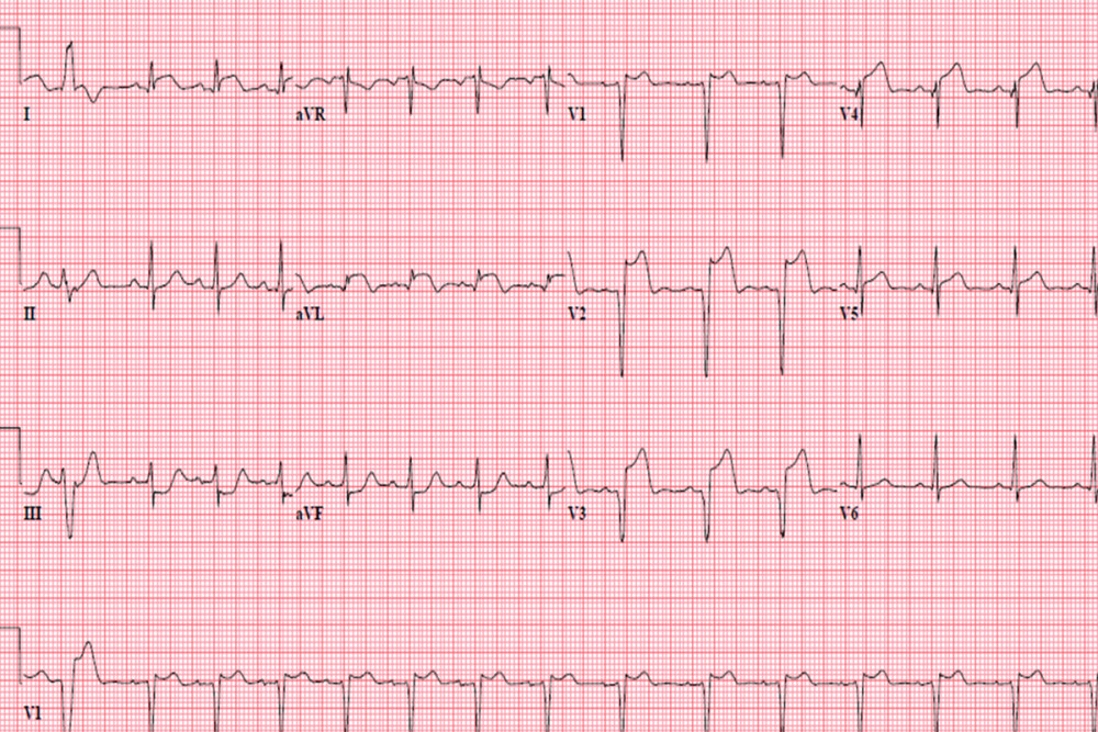 EKG on admission, demonstrating ST segment elevation in V2, V3 and V4, consistent with an anterior myocar-dial infarction in the left anterior descending artery.