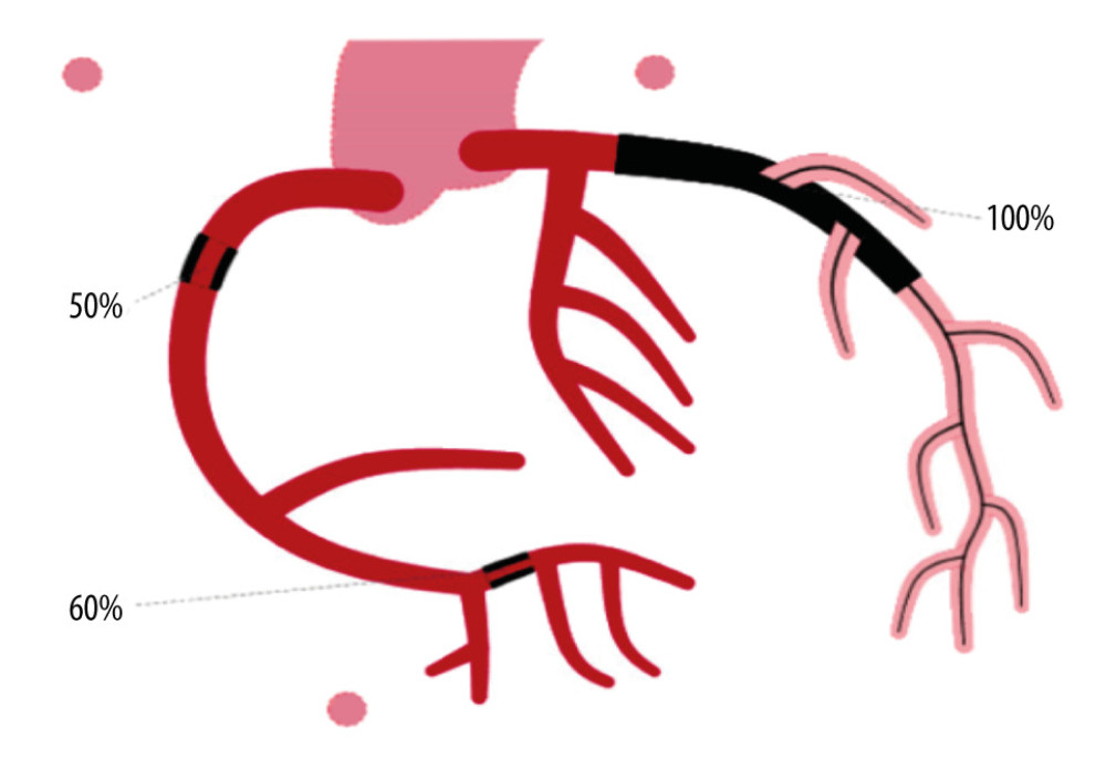 Diagram representing the patient’s condition before cardiac catheterization, showing 100% occlusion of the left anterior descending artery (black).