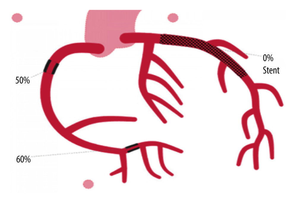 Diagram representing the patient’s condition after cardiac catheterization, showing revascularization of the left anterior descending artery, indicated as a mesh denoting a stent with 0% occlusion.