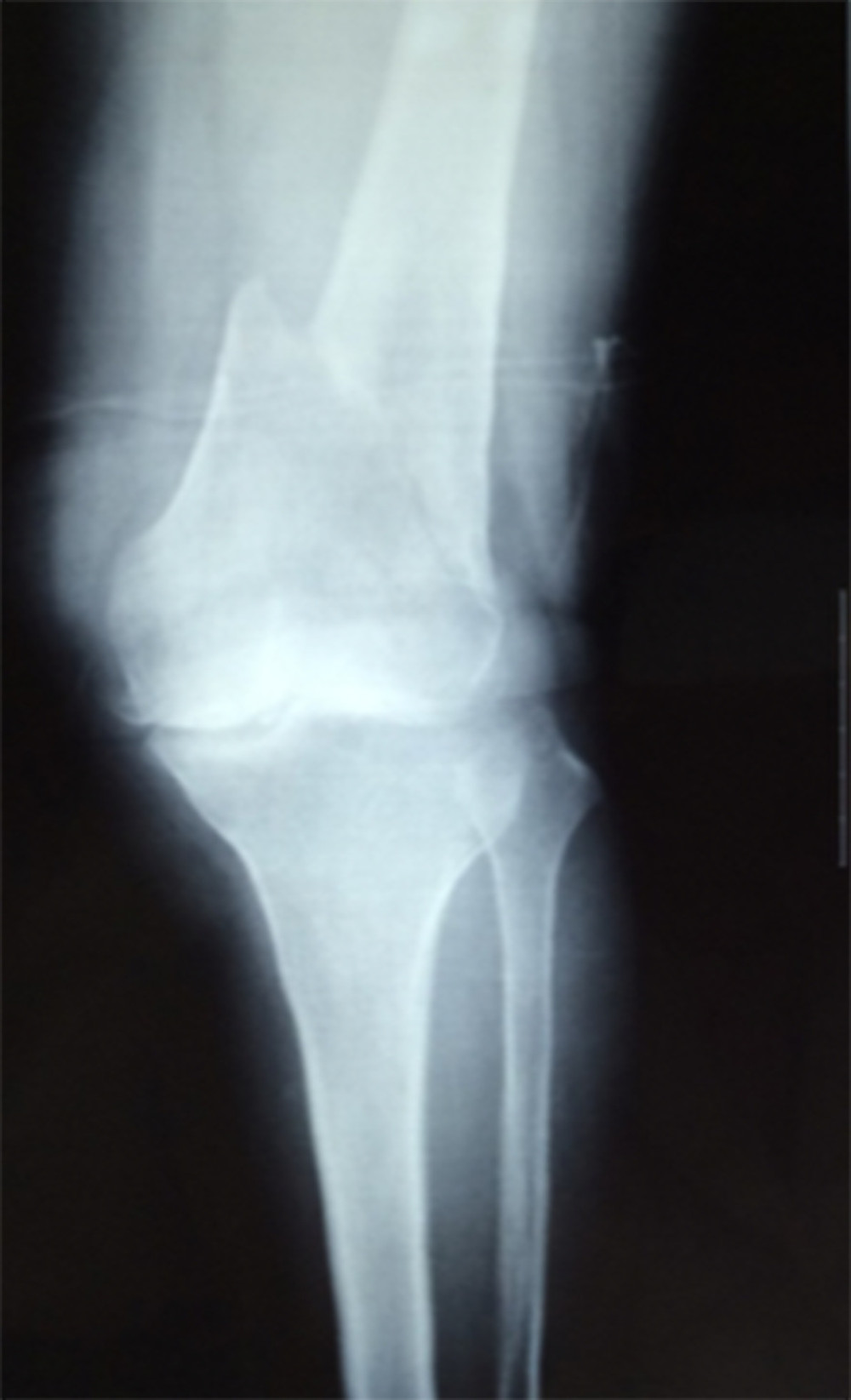 X-ray taken at 74 years old showing the fresh fracture.