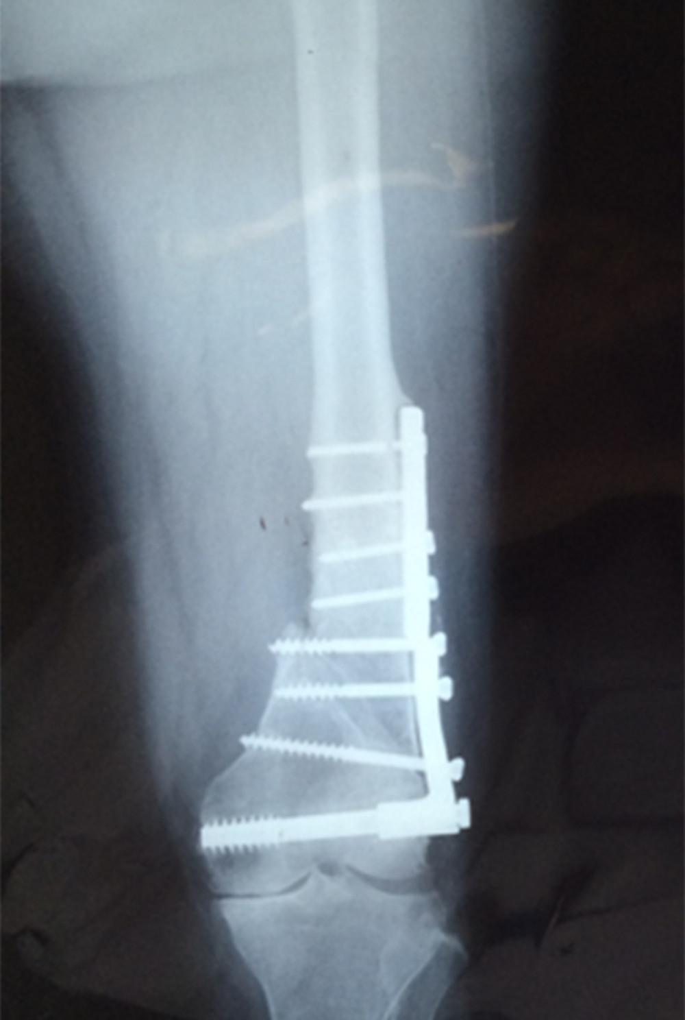 X-ray taken at 76.5 years old, after the first operation.