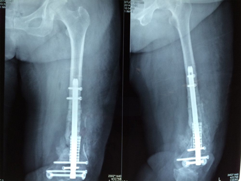 X-ray taken after implantation of the titanium cage and intramedullary nails.