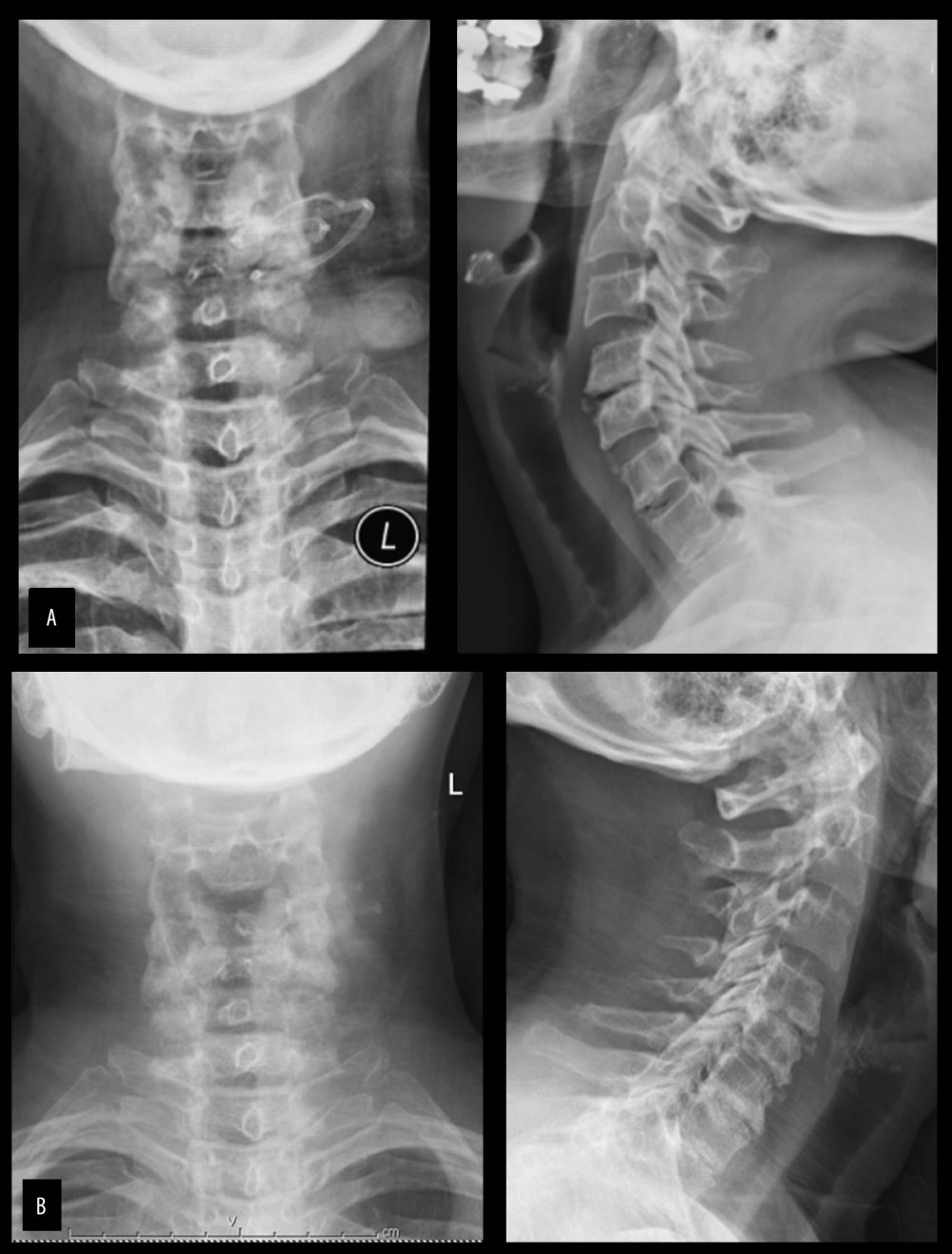 AP and lateral radiographic views of the cervical spine of our patient at her initial visit (A) and 2 years later (B).