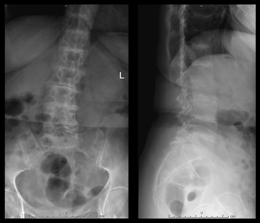 AP and lateral views of lumbar spine radiographs.
