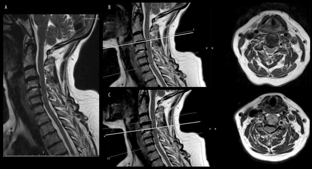 T2 MRI results in our patient. (A) Mid-sagittal T2 MRI of the cervical spine. (B) Sagittal and axial T2 MRI of the C3/4 level, showing large central disc protrusion compressing the thecal sac and spinal cord. (C) Sagittal and axial T2 MRI of the C4/5 level showing a large broad-based disc osteophyte complex compressing the thecal sac and narrowing both nerve root exit foramina.