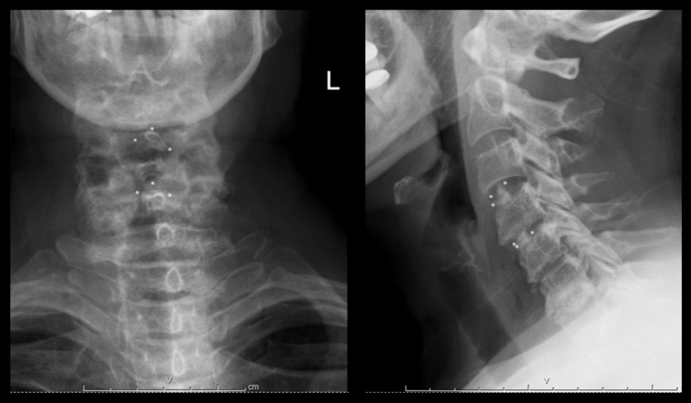 Postoperative AP and lateral radiographic views of the cervical spine.