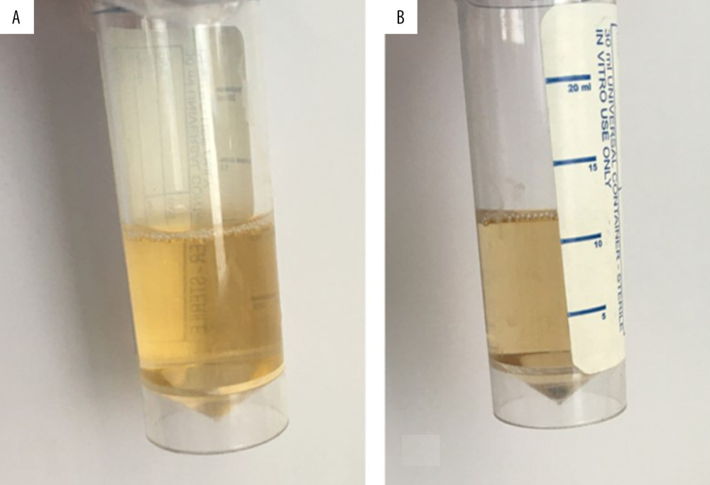 Urine sample showing the same color initially (A) and after 6 hours (B).