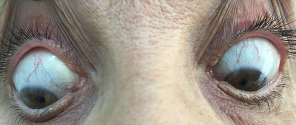 Absence of dark pigmentation of the sclerae of both eyes.