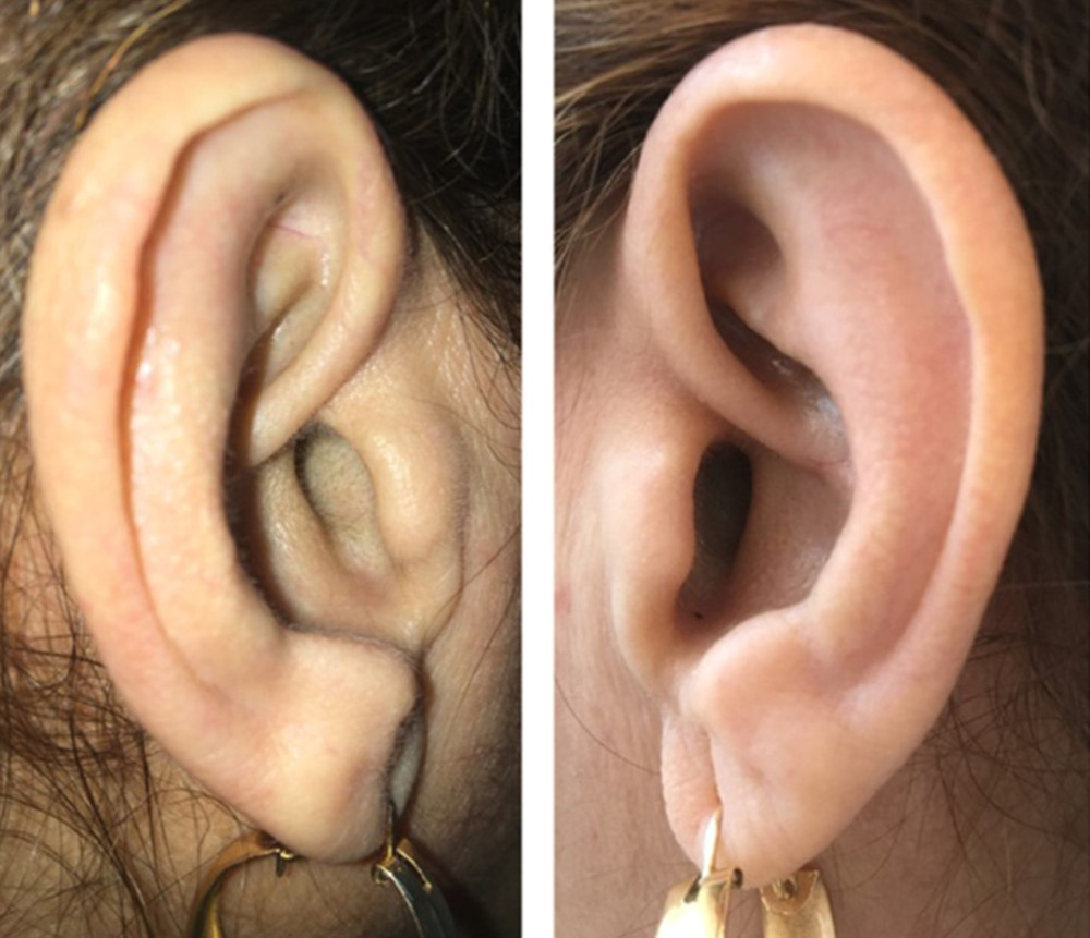 Absence of clear dark pigmentation of the pinnae of both ears.