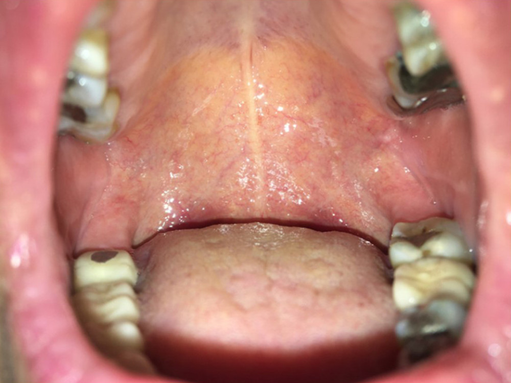 Absence of dark pigmentation of the oral cavity.