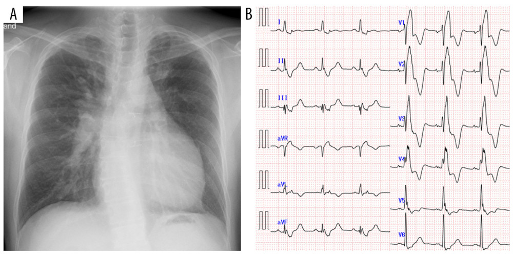 Chest radiograph and electrocardiogram of a 52-year-old man. Chest radiograph on admission shows significant cardiomegaly and dilation of the bilateral pulmonary arteries (A). Electrocardiogram on admission shows complete right bundle branch block with a QRS duration of 200 ms (B).