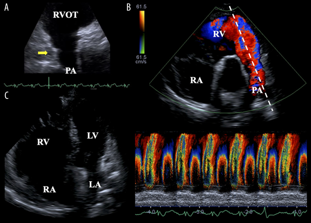 Transthoracic echocardiogram on admission of 52-year-old man. Parasternal right ventricular (RV) outflow view showing a complete regression of the pulmonary valve (A). Parasternal short-axis view shows free pulmonary regurgitation (PR). A color M-mode echocardiogram clearly shows free PR (B). Apical 4-chamber view shows prominent RV dilation as a result of free PR (C). RV – right ventricle; RVOT – right ventricular outflow tract; PA – pulmonary artery; RA – right atrium.