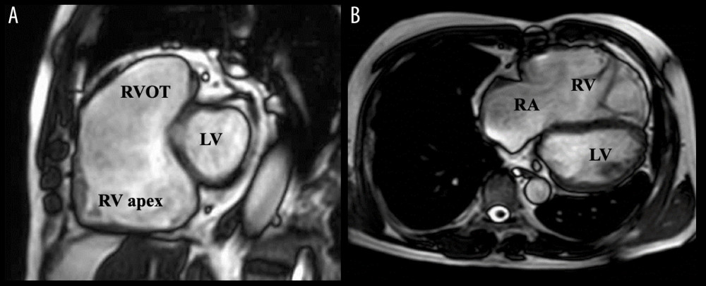 Cardiac magnetic resonance imaging of a 52-year-old man. Sagittal plane of the cardiac magnetic resonance imaging (MRI) shows a significantly dilated right ventricle (RV). Note the comparison with the adjacent left ventricle (A). Axial plane of the cardiac MRI shows the significantly dilated right atrium and RV, compressing the left side of the heart (B). RV – right ventricle; RVOT – right ventricular outflow tract; RA – right atrium; LV – left ventricle.