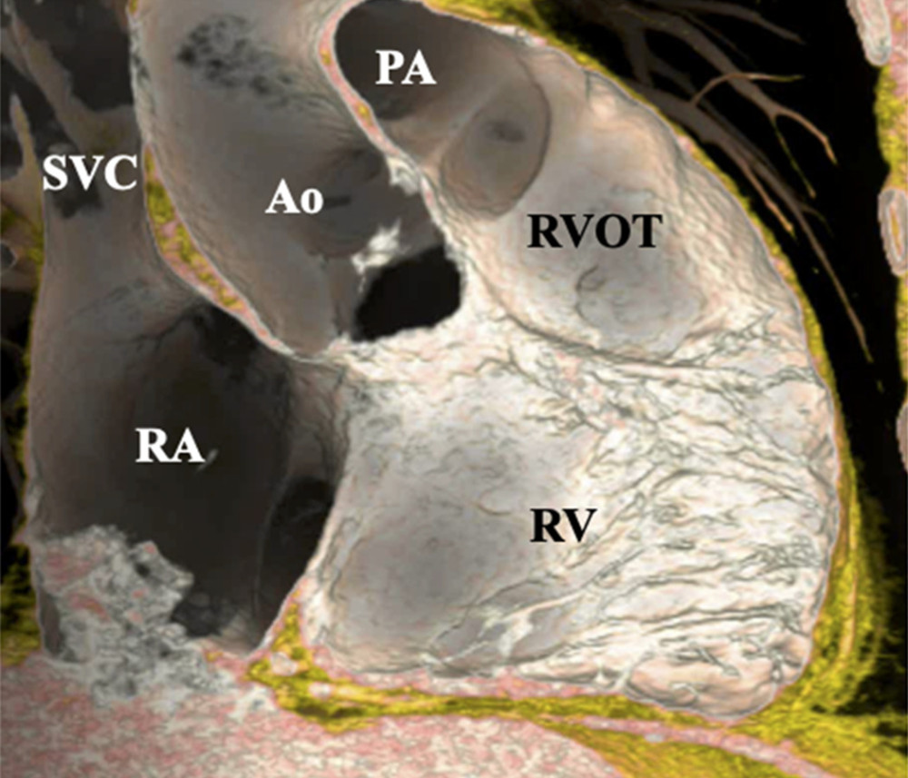 Multi-detector row computed tomography of a 52-year-old man. The three-dimensional volume-rendering image clearly shows complete regression of the pulmonary valve of the homograft. SVC – superior vena cava; RA – right atrium; RV – right ventricle; Ao – aorta; RVOT – right ventricular outflow tract; PA – pulmonary artery.