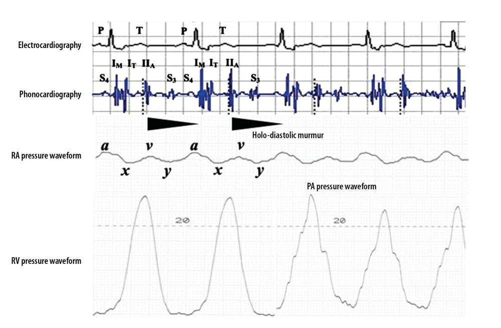Simultaneous presentation of the electrocardiogram, phonocardiogram, and pressure waveforms from the right atrium, right ventricle, and pulmonary artery. The phonocardiogram clearly shows the widely split S1, single S2, and right-sided S3 and S4. Note that S4 and S3 are coincident with a prominent a wave and deep y descent in the right atrial pressure waveform, respectively. Pulmonary arterial and right ventricular end-diastolic pressures are almost identical due to free PR. ECG – electrocardiogram; RA – right atrial; RV – right ventricle; PA – pulmonary artery.