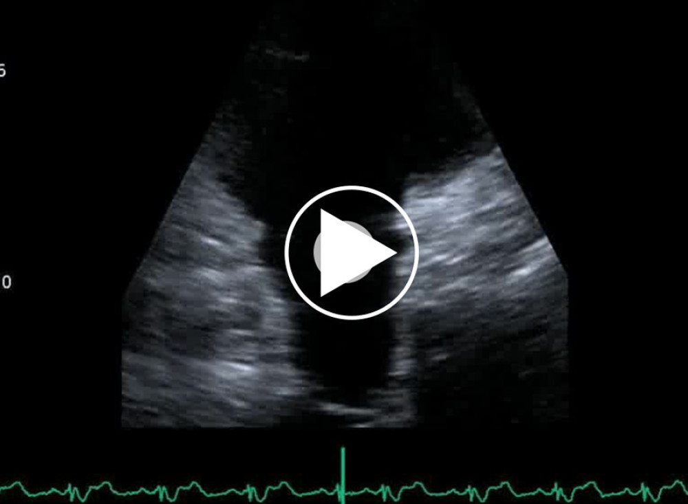 Parasternal right ventricular outflow view shows the absence of the pulmonary valve.