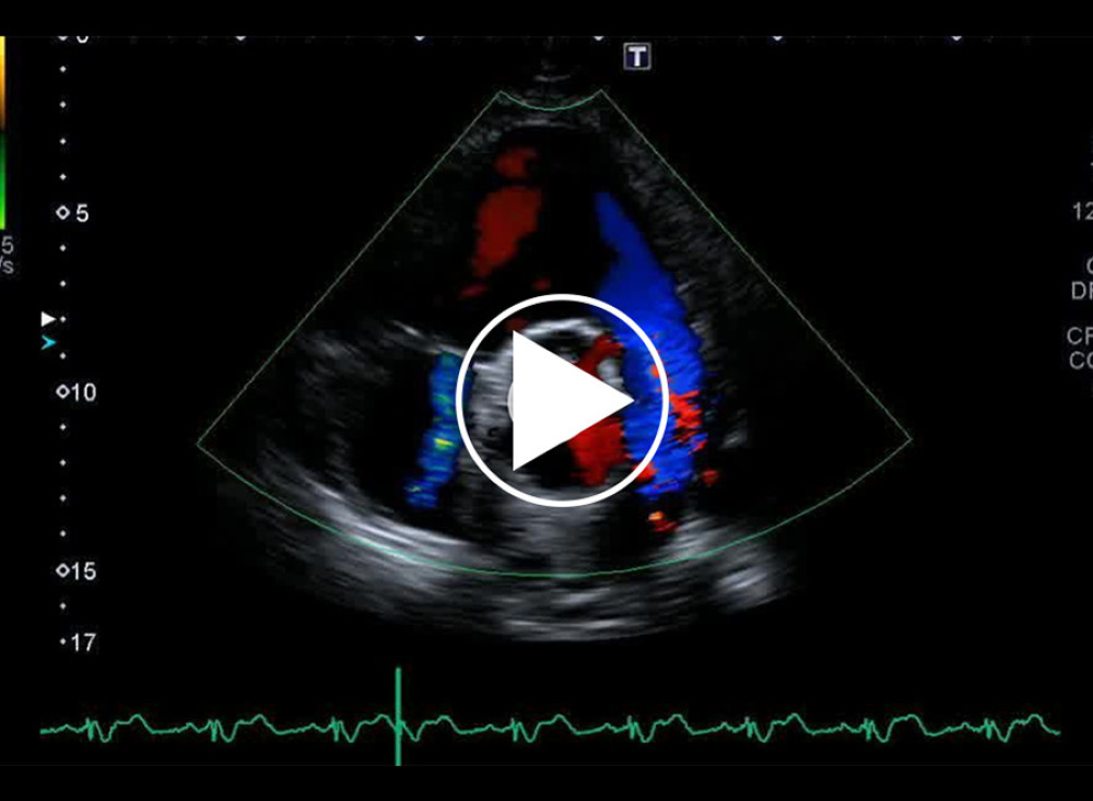 Parasternal short-axis view shows free pulmonary regurgitation.