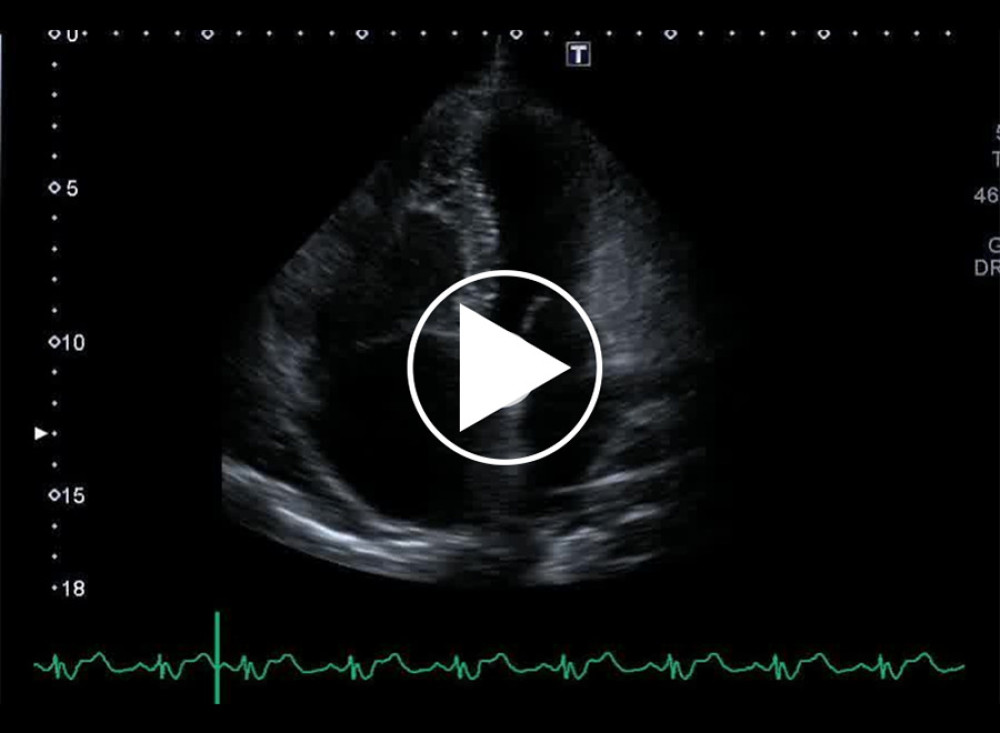 Apical 4-chamber view shows prominent right ventricular dilation.
