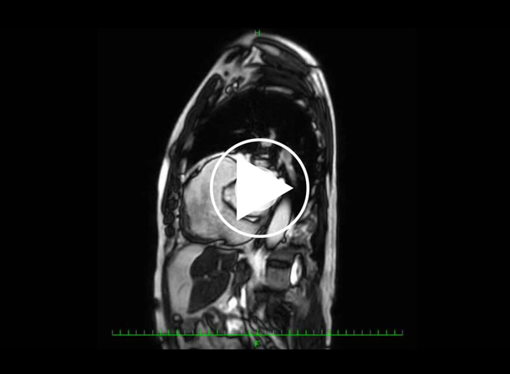 Four-dimensional sagittal plane of the cardiac magnetic resonance imaging shows a remarkably dilated right ventricle and free pulmonary regurgitation.