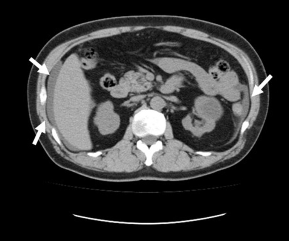 Abdominal computed tomography of the patients. Slight ascites and thickening of the peritoneum with edema were found (arrows).